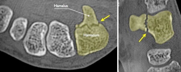 Hamate fracture | www.hand-surgery.eu