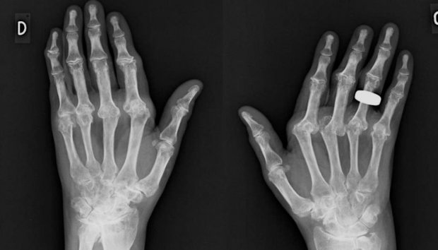Arthrite rhumatoïde | www.hand-surgery.eu Arthrite rhumatoïde | www.hand-surgery.eu
