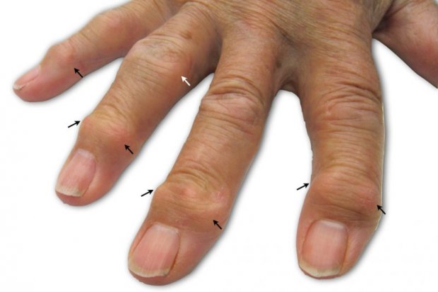 Osteoarthritis Of The Fingers Hand Surgeryeu