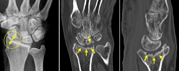 Osteoarthritis of the wrist | www.hand-surgery.eu