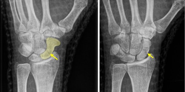 Scaphoid fracture | www.hand-surgery.eu