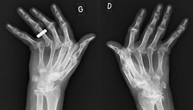 Arthrite rhumatoïde | www.hand-surgery.eu Arthrite rhumatoïde | www.hand-surgery.eu