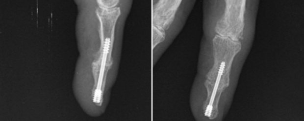 Osteoarthritis Of The Fingers Hand Surgeryeu
