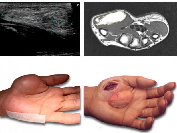 Mélanome Métastatique
