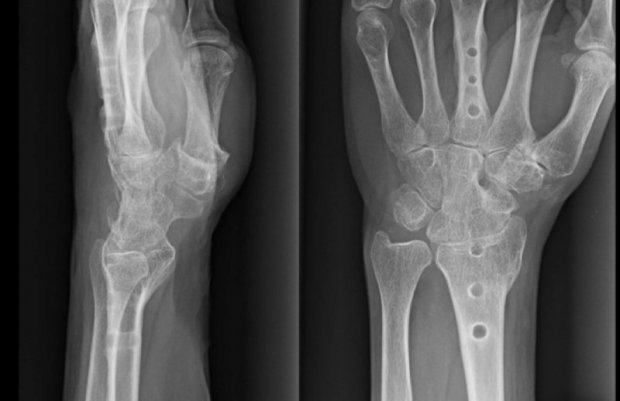 Osteoarthritis of the wrist | www.hand-surgery.eu