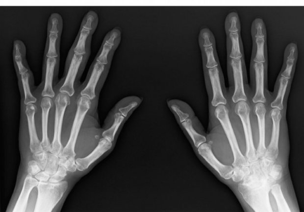 Arthrite rhumatoïde | www.hand-surgery.eu Arthrite rhumatoïde | www.hand-surgery.eu