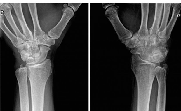 Arthrite rhumatoïde | www.hand-surgery.eu Arthrite rhumatoïde | www.hand-surgery.eu
